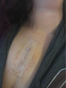 Two days post Mediport surgery.